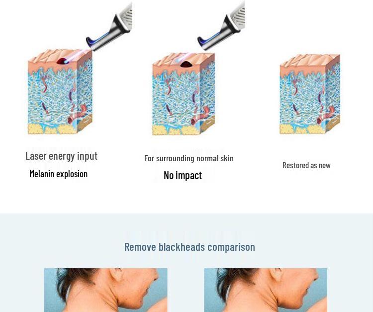 Portable Picosecond Laser Pen for Tattoo, Freckle, and Eyebrow Removal with Red & Blue Light