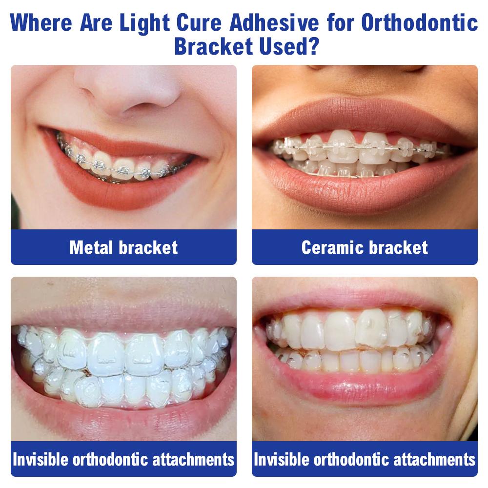 Dental Orthodontic Adhesive Kit Light Cure Glue Metal Ceramic Brackets Braces Invisible Bonding Dentistry Tools Dentist Material