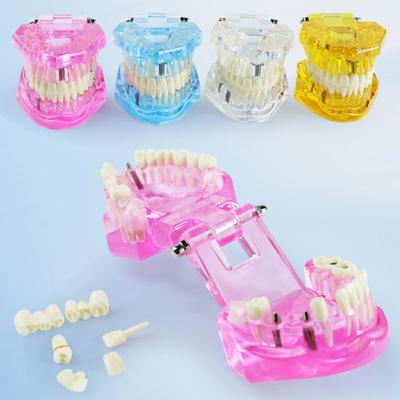 Dental Implant Model Teaching Aid for Dentist Student School Removable Teeth Orthodontic Demo Models Dental Prosthetic Demonstration