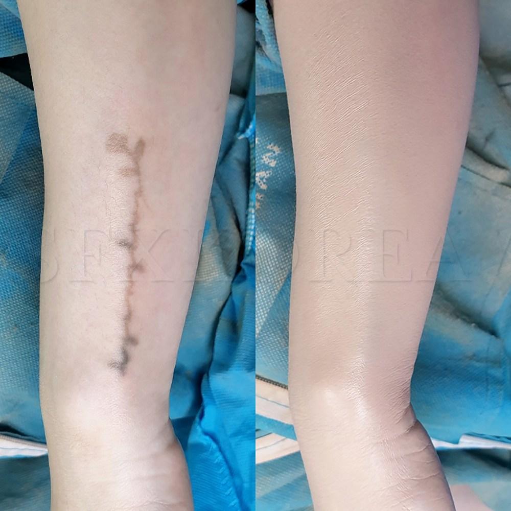 Tattoo cover, tattoo, vitiligo, scars, freckles, coffee spots, thin veins, blemishes concealer, SFX tattoo cover 1 set