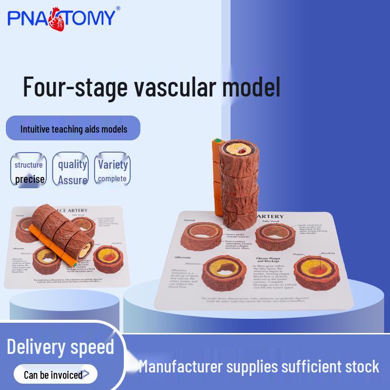 Human Blood Vessel Model: Four Stages of Arteriosclerosis for Cardiology Demonstration and Doctor-Patient Communication 14*5*5 cm