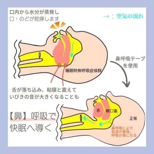 Nasal Breathing Tape, 15 Sheets x 5 Packs, 75-Day Supply, Made in Japan, Night Tape [Dry Mouth & Throat] Individually Wrapped, Daikyo Pharmaceutical C