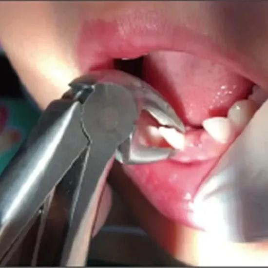GDC Extraction Forceps Lower Premolars Pedo Standard (FX1CS)