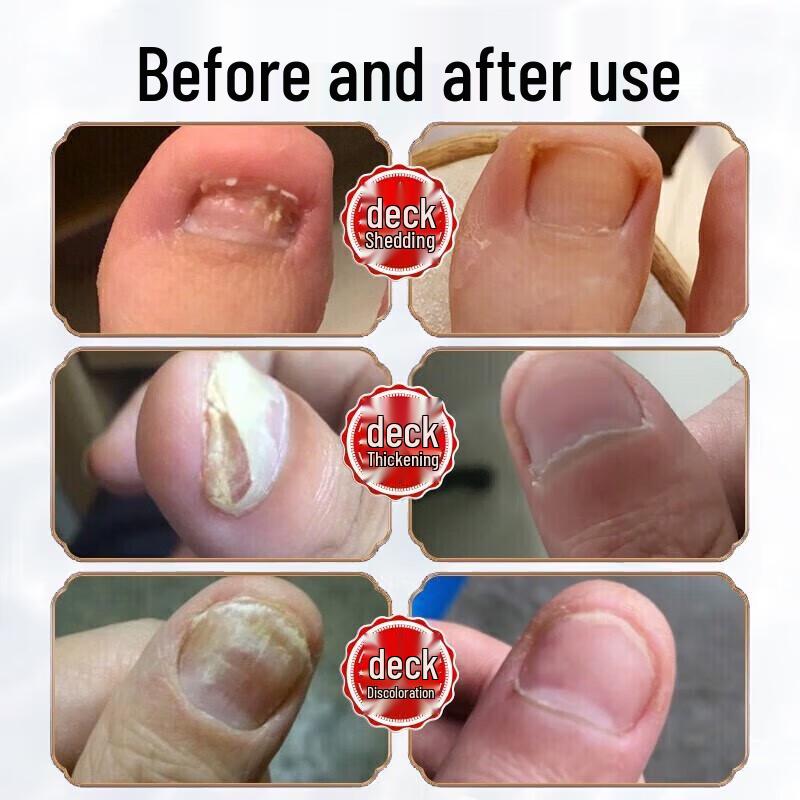DR.JOINTNA Fungal Nail Treatment