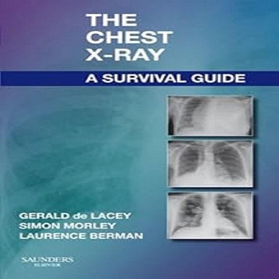 

The Chest X-Ray: A Survival Guide paperback UKN315