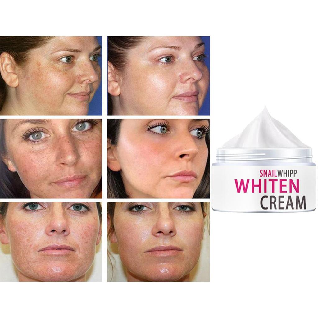 Facial freckle cream targets black spots and irregular pigmentation to reduce black spots  Skin Whitening, Moisturizing