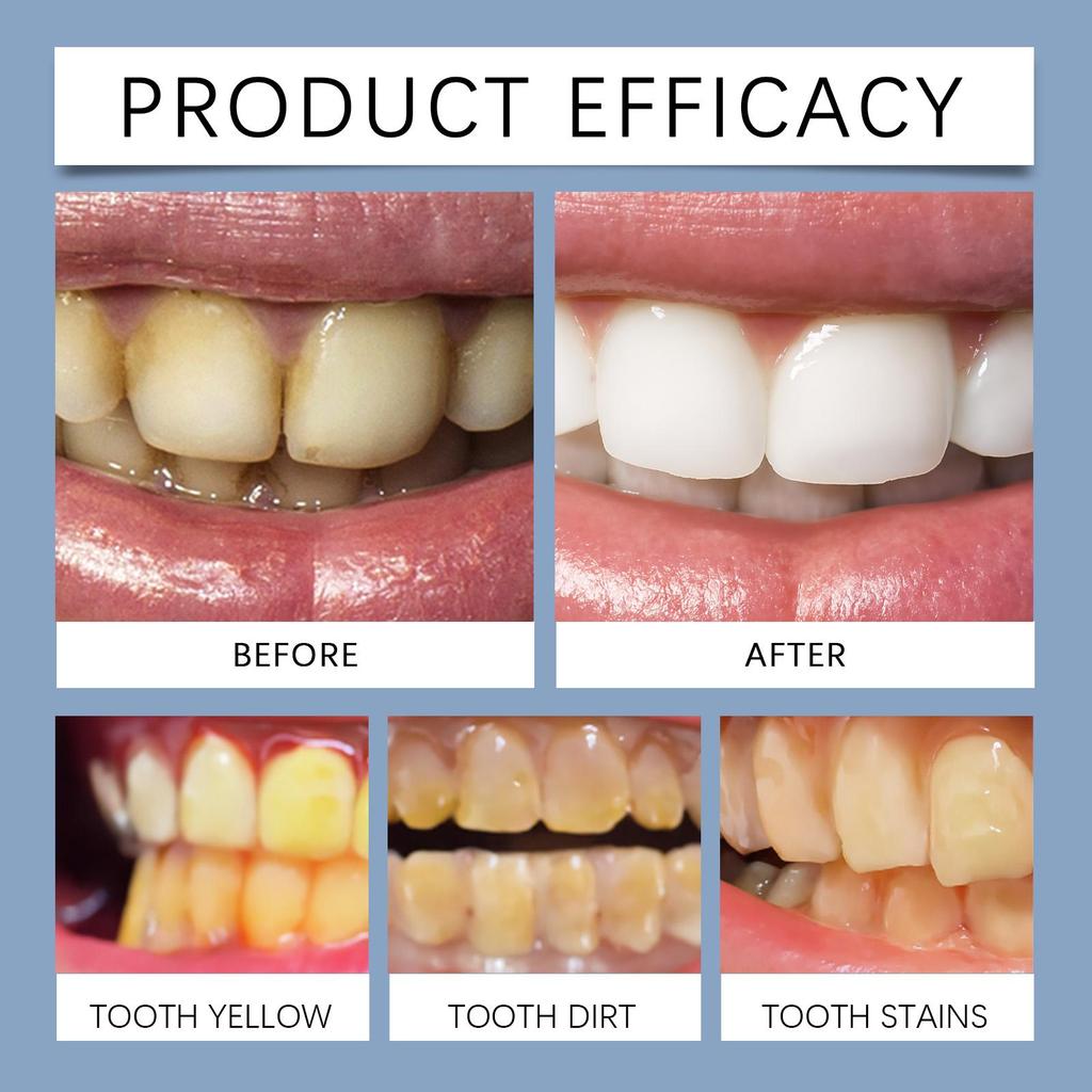 Best-Selling Teeth Care Whitening Kit, Stain Removal & Tooth Protection - Visible Glow In 3 Days