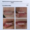 Feuchtigkeitsspendender Lippenbalsam für trockene, rissige Lippen & Cheilitis