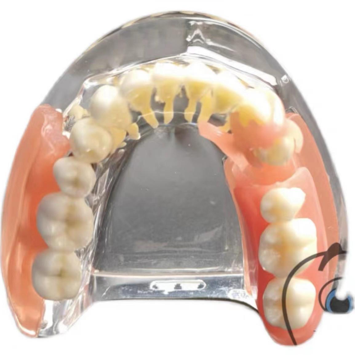 Dental Oral Cavity Model for Doctor-Patient Communication - 4-Pin Implant & Restoration Model