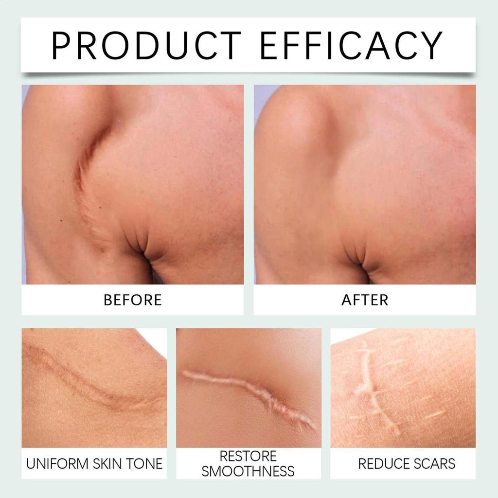 Silicone Scar Patch Skin Repair Sheets Removal Self-Adhesive Stretch Mark Tape Therapy Patch For C-Section Burn Acne Scar
