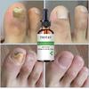 7DAYS Repair Nail Fungus Treatments Essence Foot Care Serum Toe Nails Fungal Removal Gel Anti-Infection