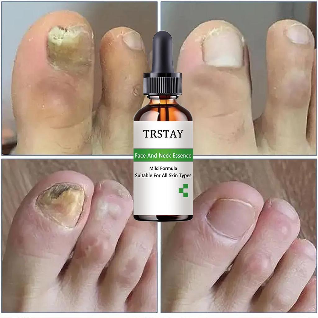 7DAYS Repair Nail Fungus Treatments Essence Foot Care Serum Toe Nails Fungal Removal Gel Anti-Infection