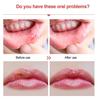 Red Light Therapy Cold Sore Device For Mouth Sores Treatment 660nm 850nm NearInfrared LED Light Therapy Machine Skin Care Wand