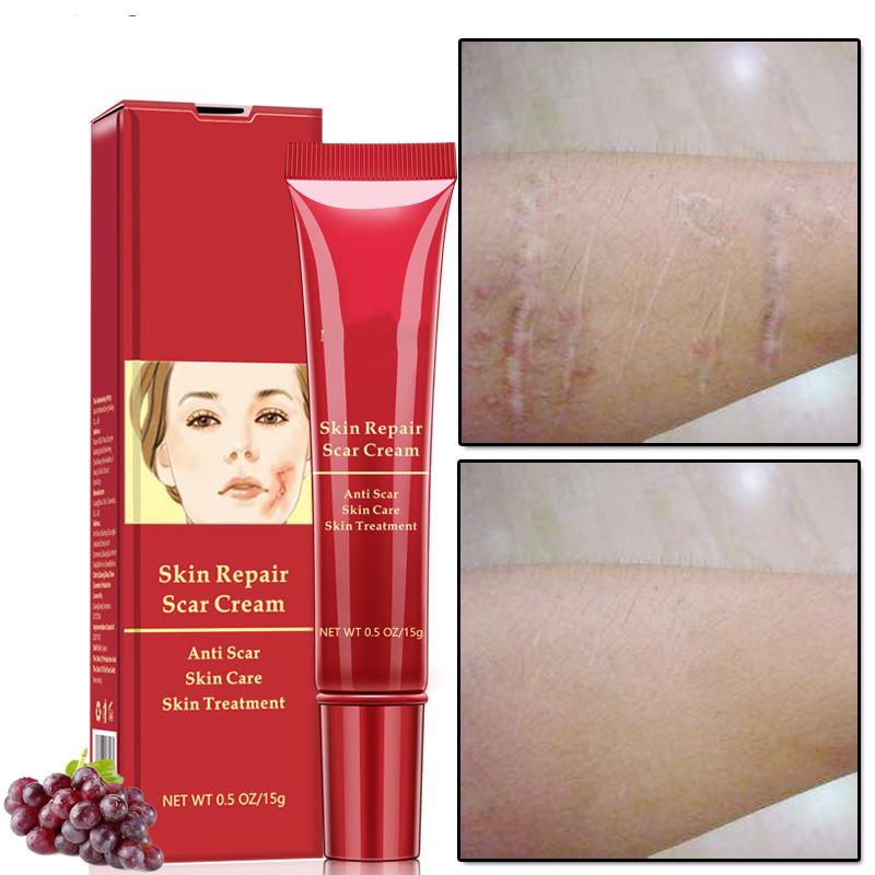 Scar Removal Cream for All Skin Types - Reduces Scars, Acne Marks, and Stretch Marks