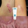 Acne Scar Removal Cream Pimples Stretch Marks Face Gel Remove Acne Smoothing Whitening Body Skin Care Pigmentation Corrector