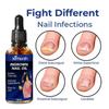 Ingrown Nail Oil