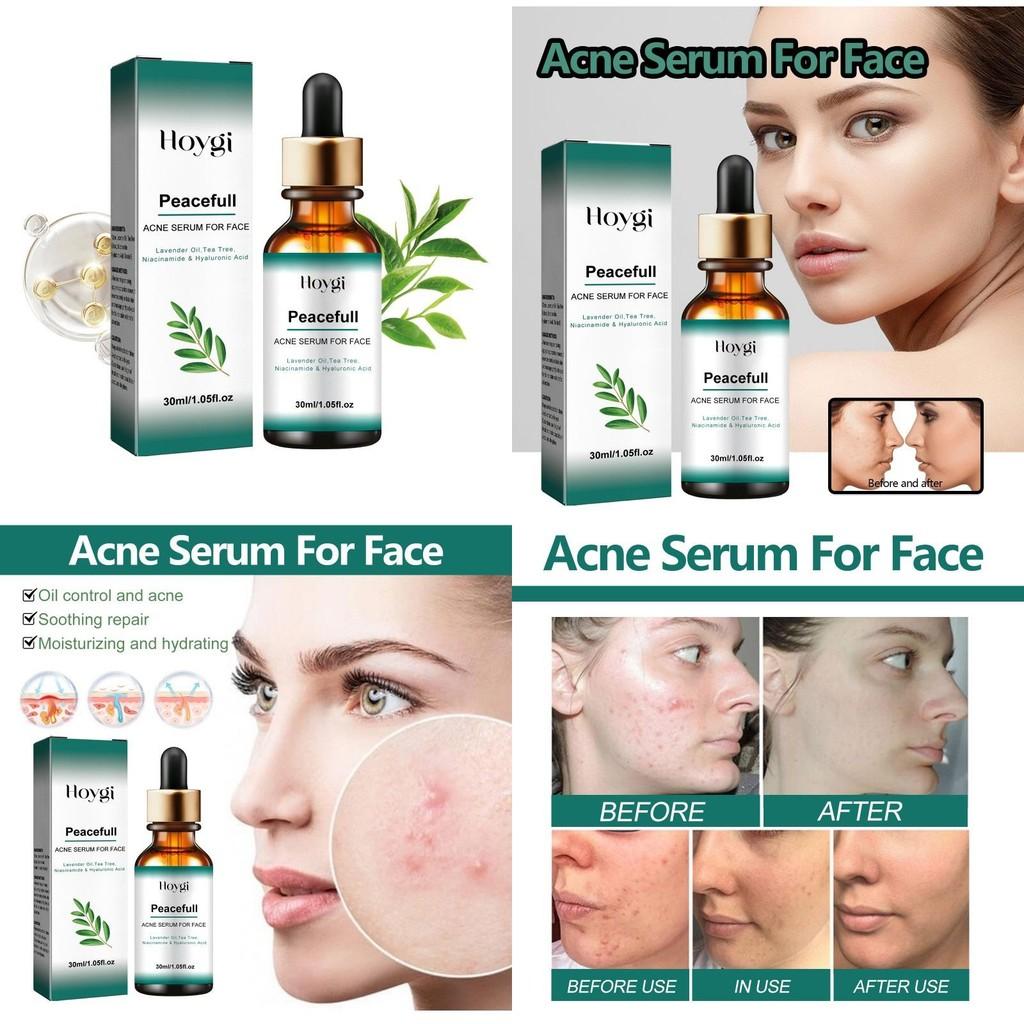 Hoygi Acne Essence With Hydrating Properties For Reducing Blemishes And Pore Refinement