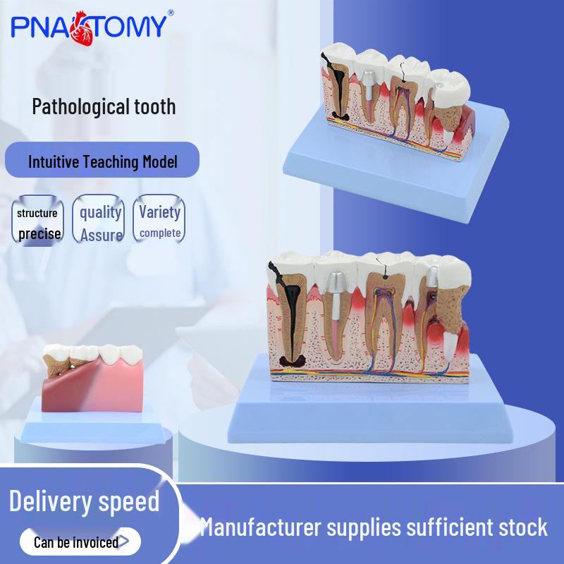 Pathological Dental Anatomy Teaching Model - Magnified Tooth 18x14x11 cm