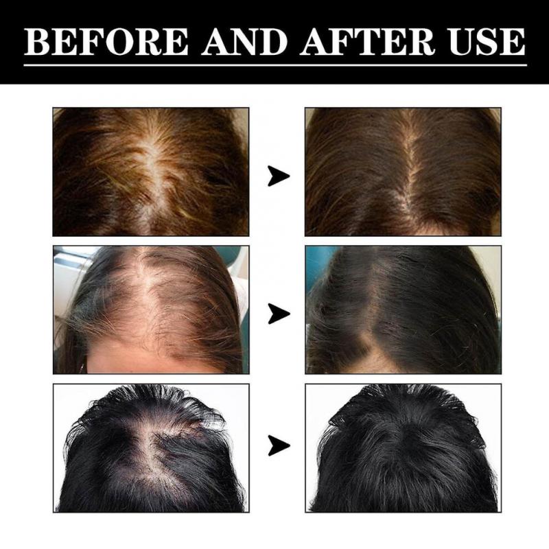 Hair Growth Serum, Jaysuing: Prevents Hair Loss, Nourishes Dry and Damaged Hair, Promotes Natural Hair Growth, and Prevents Hair Loss