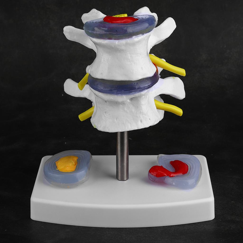 Anatomical Lumbar Disc Herniation Demonstration Model Human Spine School Training Supplies