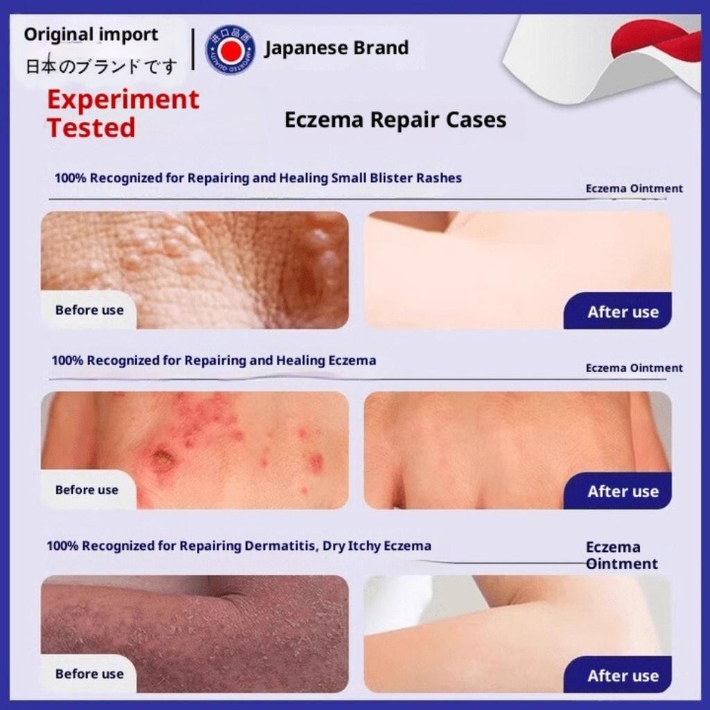 Eczema and Dermatitis Ointment This ointment helps remove dampness relieve itching, and can be used externally Ointment for fungal infection