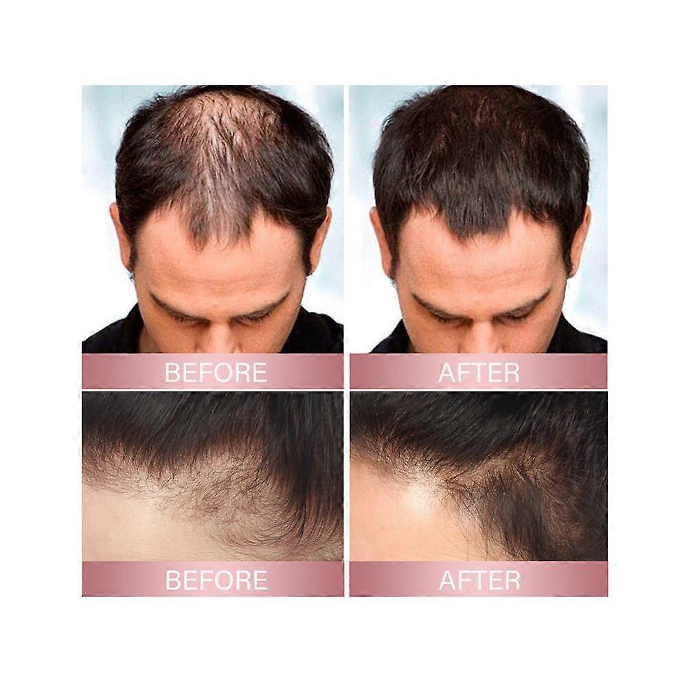 3Pcs Zephta H-Regrow 2.0, Zephta Hair Regrowth, Prorevita Rice Nutri Spray, for Hair