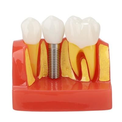 Dental Implant Model Removable Analysis Crown Bridge Demonstration Tooth Model Education Learning