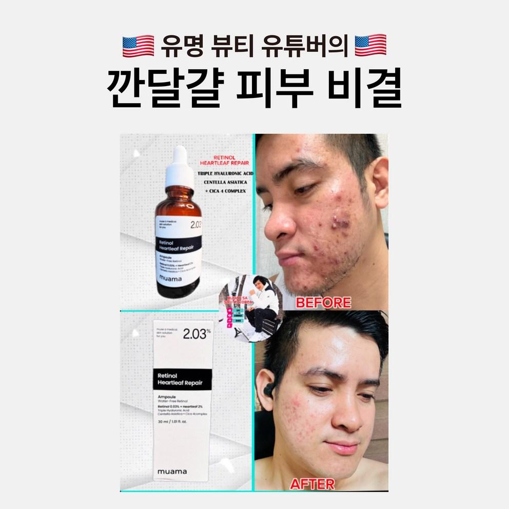 [MUAMA] 3-Tage Aknebehandlungs-Ampulle - Beruhigend, Talgreduzierend, Porenverfeinernd, Retinol, Houttuynia Cordata, Hyaluronsäure, Niacinamid, 30ml