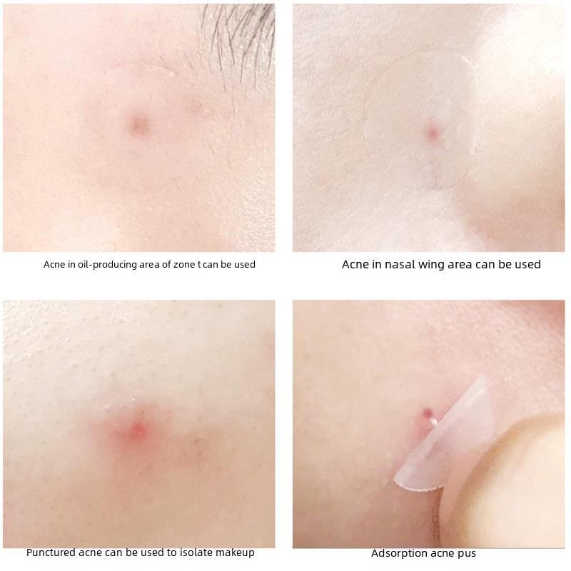 """Unsichtbares Hydrokolloid-Akne-Pflaster für Tag und Nacht"""