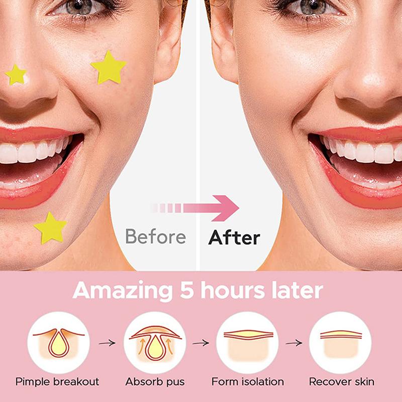 112 Pcs/Set Pimple Patch Acne Colorful Invisible Acne Removal Skin Care Stickers Concealer Face Spot Beauty Makeu