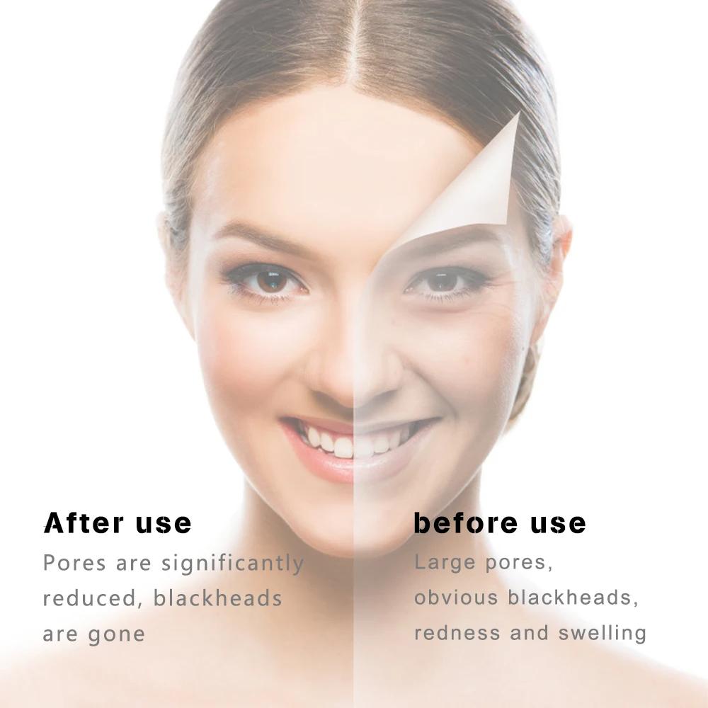 Beauty Instrument 6 Nozzle Facial Vacuum Pore Cleaner. Instrument for cleaning pores and blackheads. Instrument for facial cleansing and exfoliation