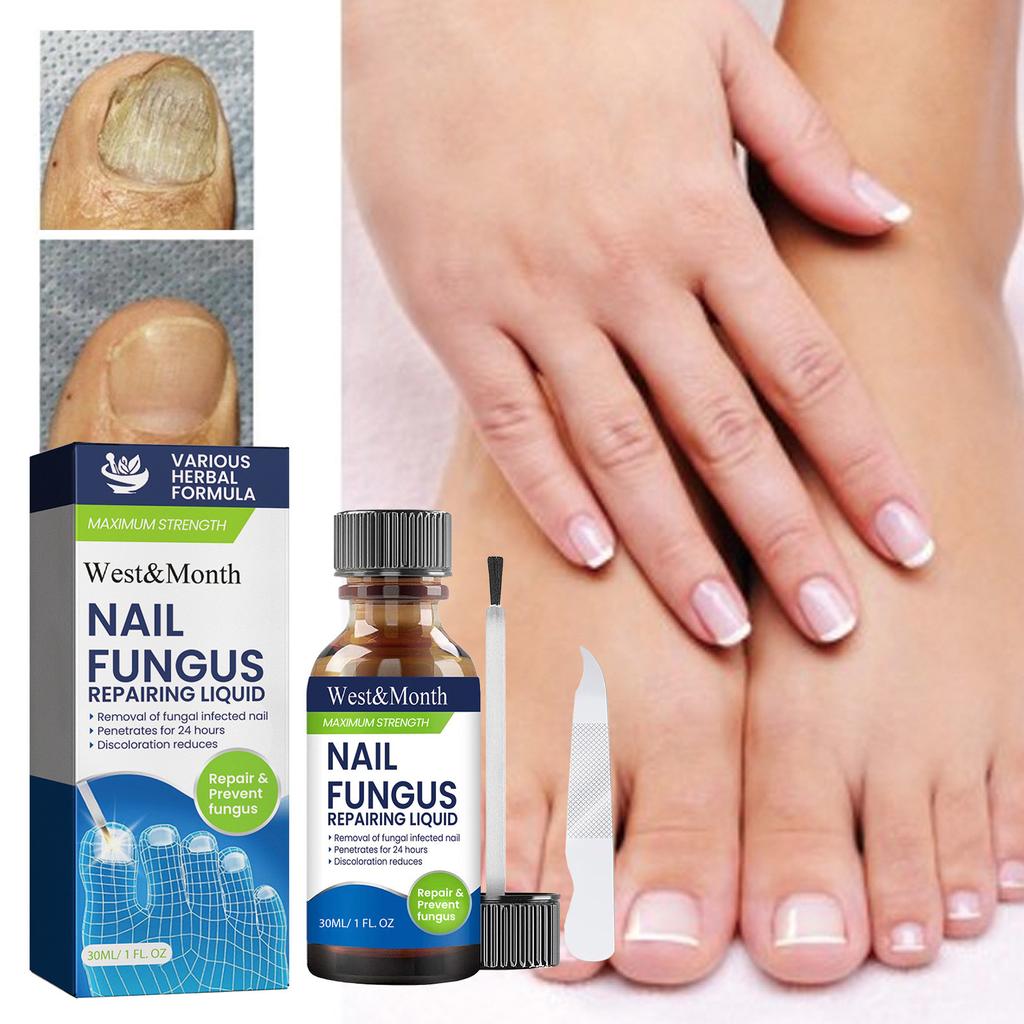 Onychomycosis Solution, Thickening Bright Onychomycosis Remover, Soft Onychomycosis, Hand And Foot Nail Care Solution 30ml