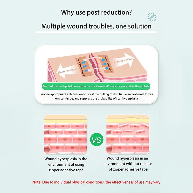 1 Sheet Fast Suture Zipper Band-Aid Zipper Tie Wound Closure Patch Hemostatic Patch Wound Outdoor Portable