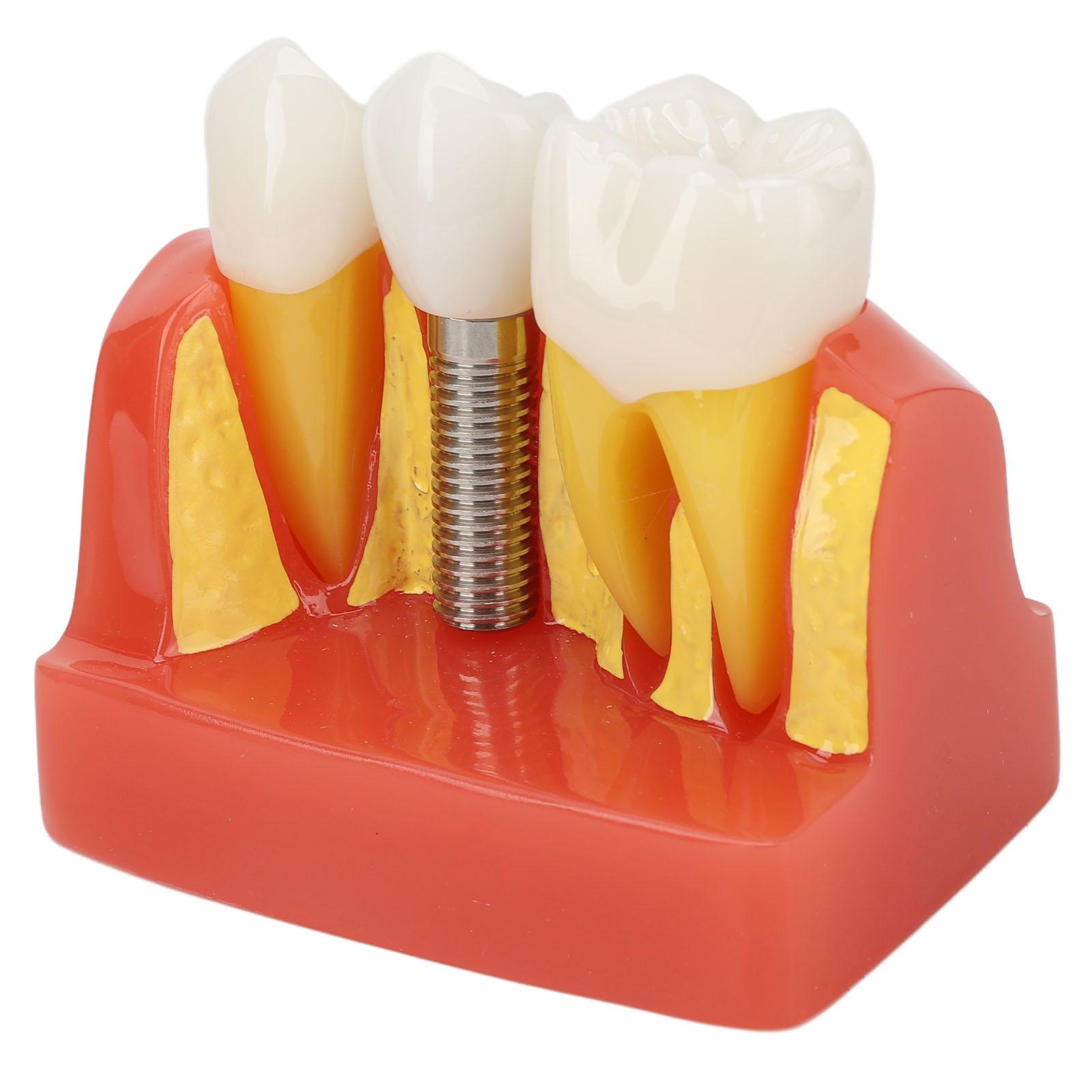 

Модель зубного имплантата Съемный анализ Коронка Мост Демонстрация Модель зуба Образование Обучение