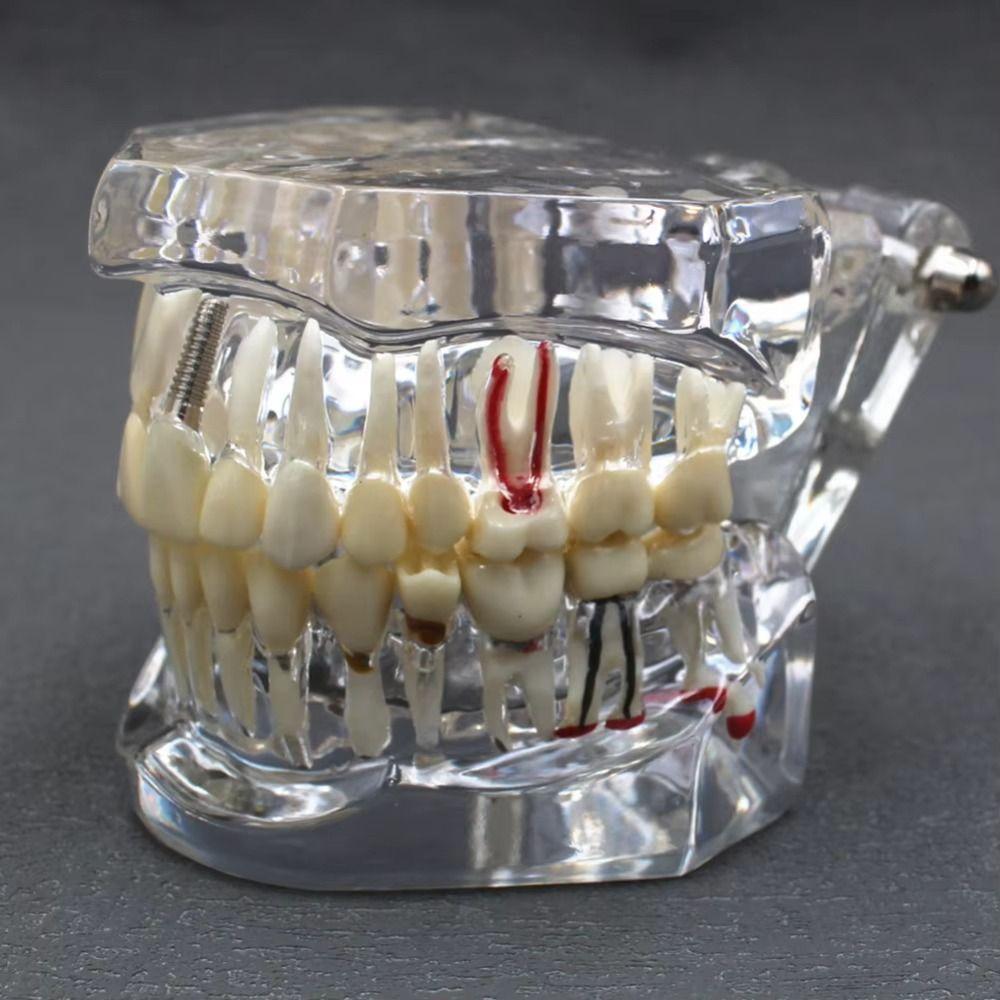Model dentar transparent Tipuri multiple Modele standard cu implanturi Predare Stomatologie Studiu