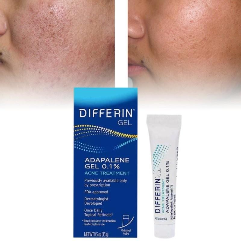 Differin Acne Treatment Gel Retinoid Gel For Clear Radiant Skin 15g