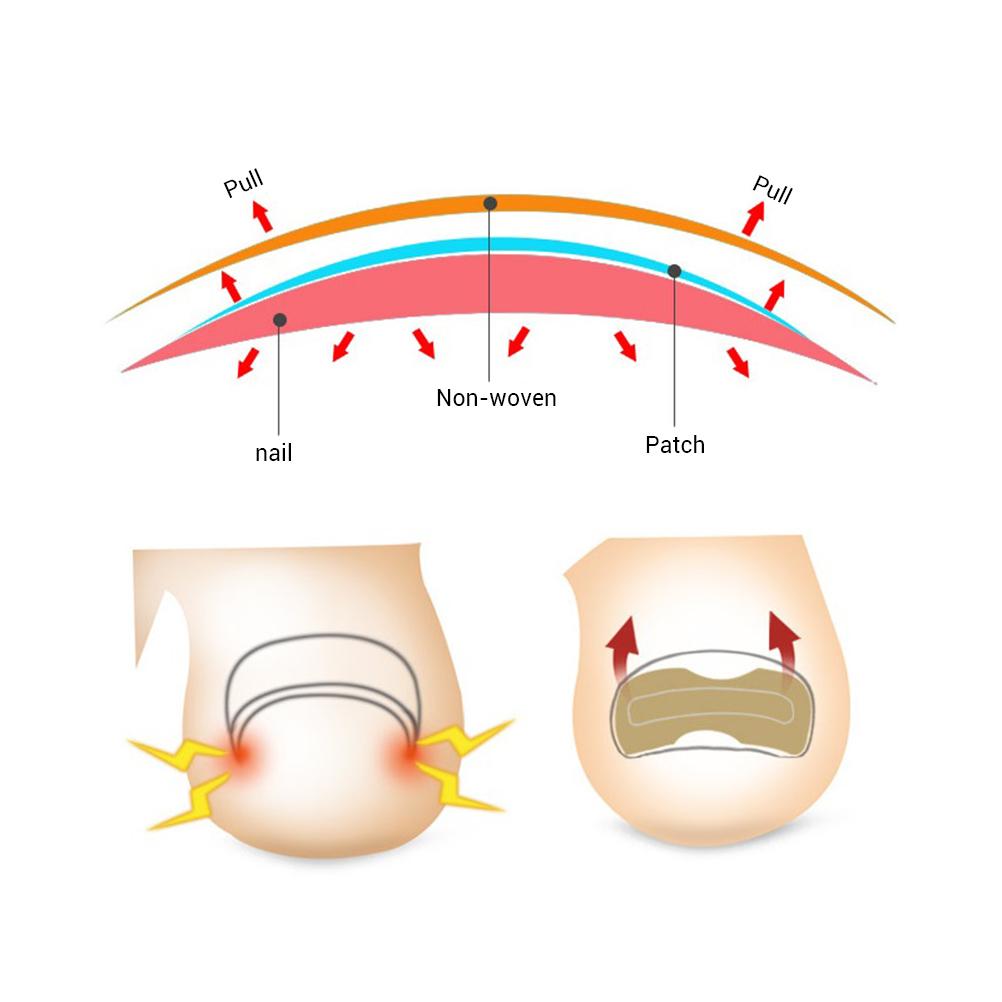 100 Stück eingewachsener Zehennagel Korrektur Aufkleber mit doppelseitigem Klebeband Paronychie Korrektur Pediküre Werkzeuge