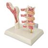 Osteoporosis Spine Model Demonstrating Educational Osteoporosis Lesion Model for Clinical Teaching