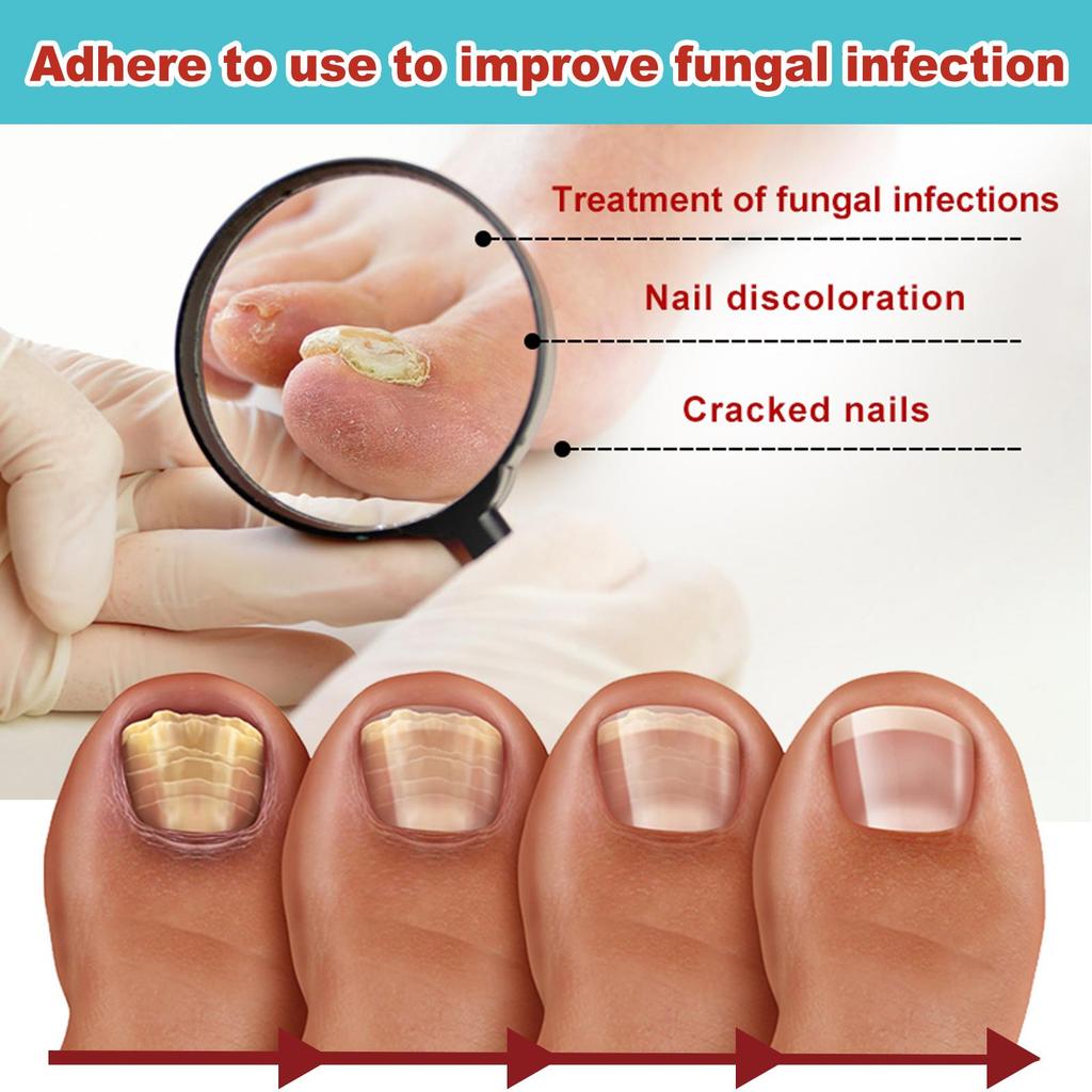 16pcs/box Foot Nail Repair Patch Grey Fungal Nail Thicken Soft Paronychia Infection Hand Nail Correction Sticker Ingrown Toenail