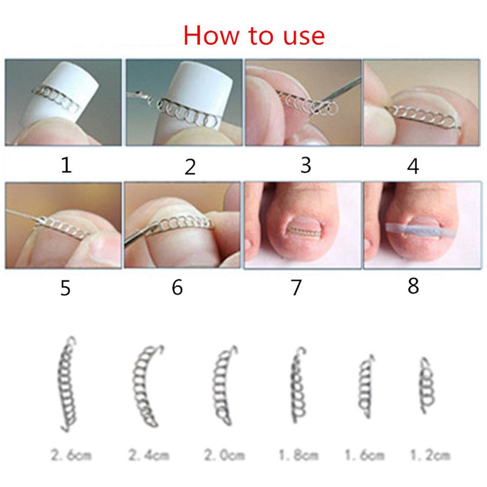 12 Pcs/box Ingrown Toe Nail Correction Pedicure Wire Fixer Paronychia Recover Tool