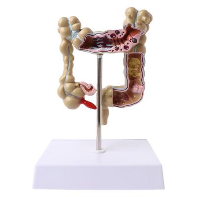 Human Colorectal Lesion Model Pathological Anatomy Colon Disease Intestine Medical Teaching Learning