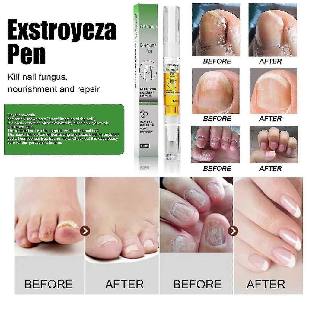 Exstroyeza Nail Repair Pen - Fungal Treatment & Nourishing Solution for Healthy, Clear Nails On Hands & Feet - 5ml Portable Nail Care for Bacterial In