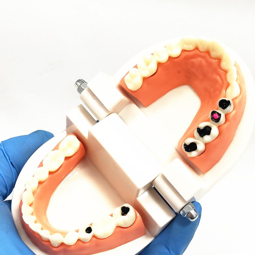 1 Piece Dental Tooth Model Standard Teeth Model Dental Caries Model for Patient Communication Dentist Study Model with Decayed Tooth