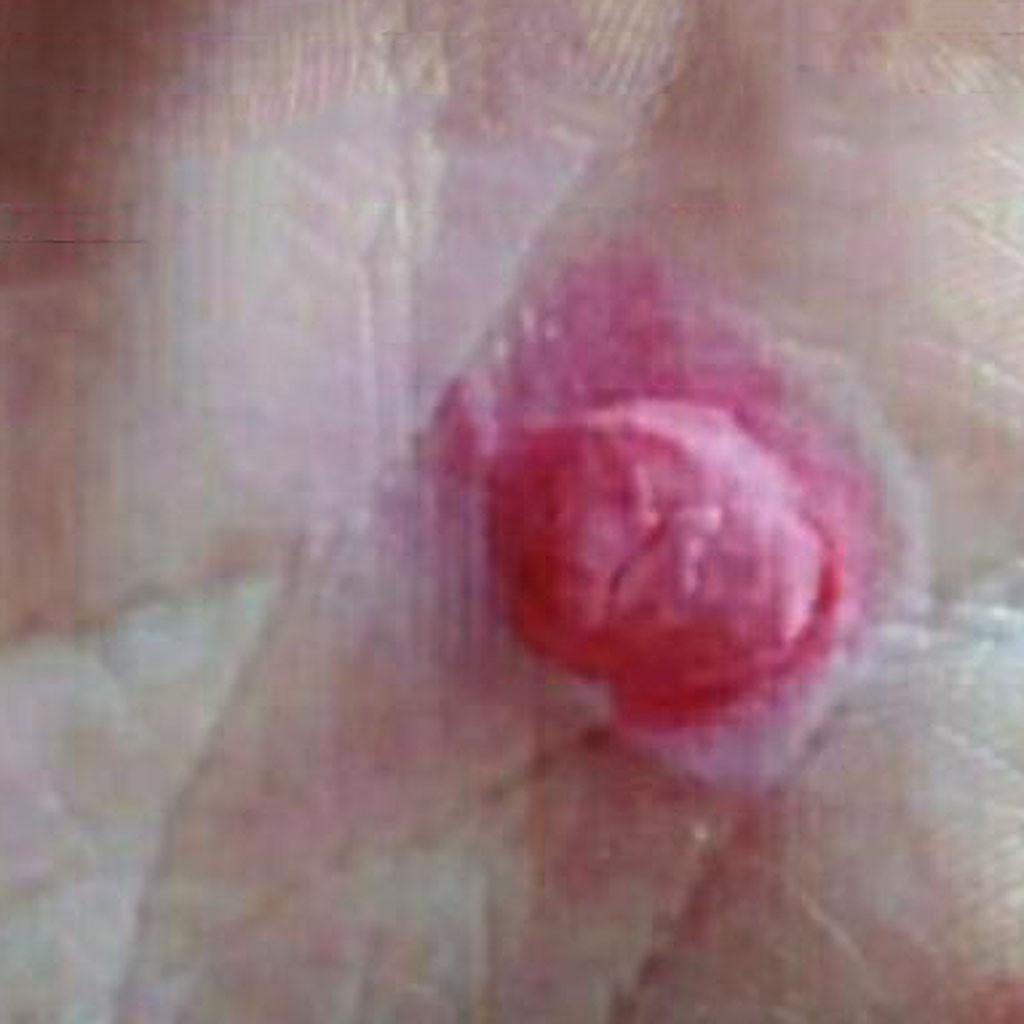 Foot Corn Remover Plaster Foot Pad Patches  Patch Pain Foot Care Tools