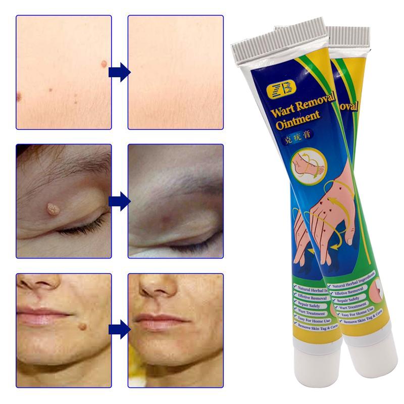 ZB Mole Removal Ointment Skin Care Mild Ingredients Collagen Daily Skin Care