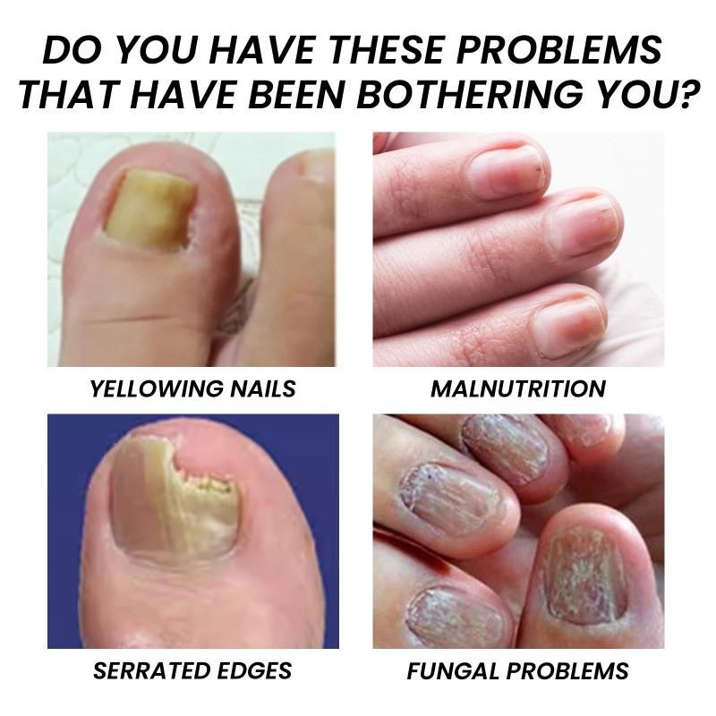 Nourishing Jaysuing Nail Repair Essence For Healthy Strong Nails 30ml