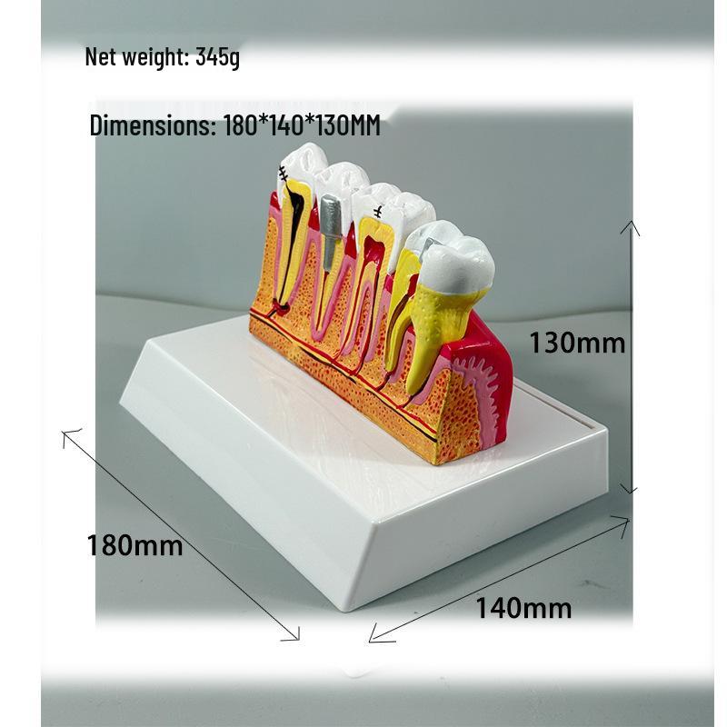 Прозора Знімна Повна Модель Щелепи з М'якими Яснами та Зубами для Підготовки до Імплантації
