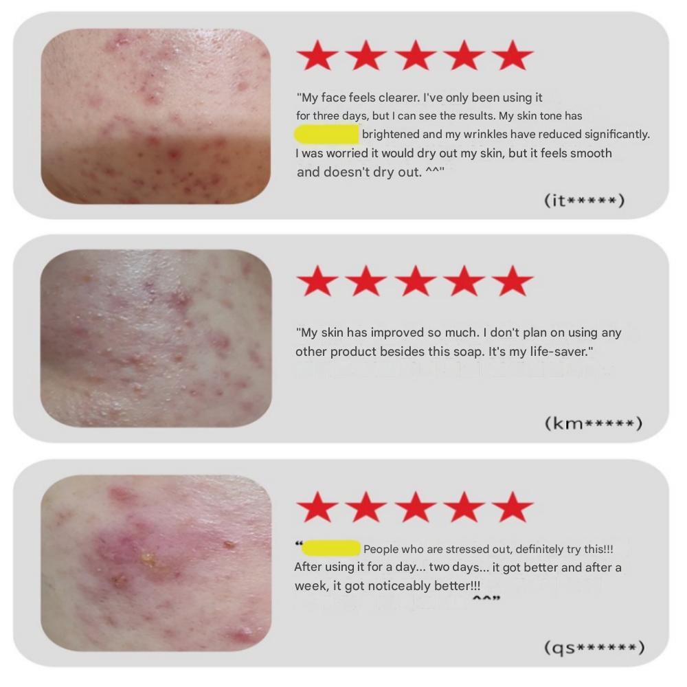 Miracle Folliculitis Soap, Handmade Natural Soap with Houttuynia cordata, 100g x 2