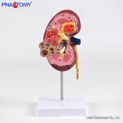 Pathologisches menschliches Nierenanatomie-Modell – Krankes Organ Lernwerkzeug