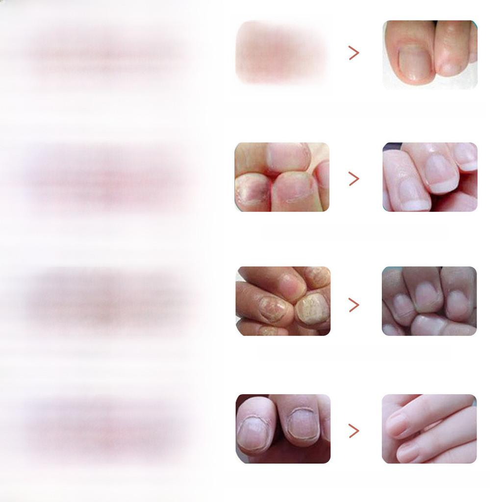 Преміальний розчин для відновлення нігтів на ногах 5 мл Для знебарвлених нігтів і пом'якшення нігтів